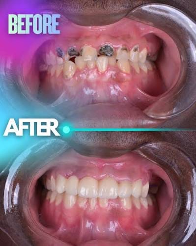Happy Patient - Dental Crowns Uttam Nagar New Delhi